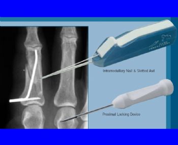 Small Bone Fixation System for the Hand (Prod 1659)